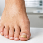 La javel est-elle vraiment efficace contre la mycose ongle pied ?