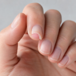 Ongle arraché, que faire pour bien réagir en urgence ?
