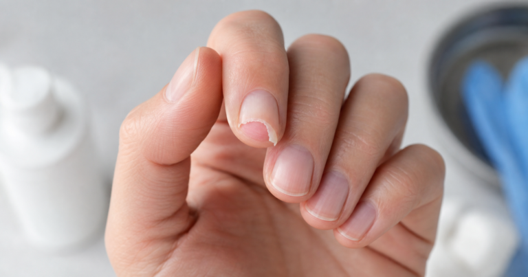 Ongle arraché, que faire pour bien réagir en urgence ?