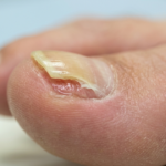 ongle qui se decolle