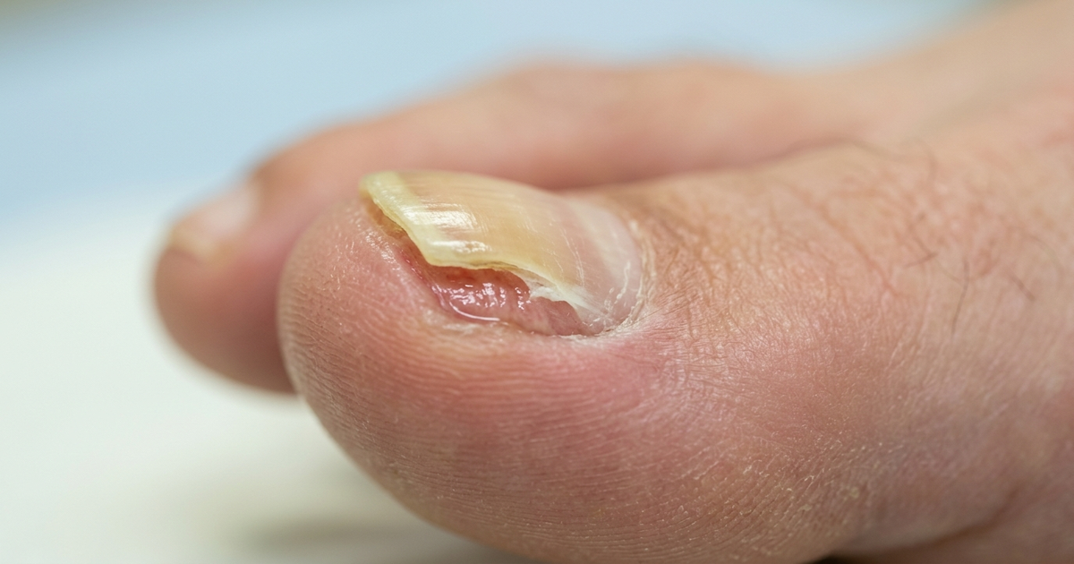 ongle qui se decolle