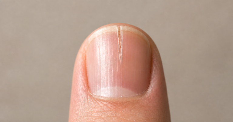 Pourquoi mon ongle se fend toujours au même endroit et comment le réparer ?
