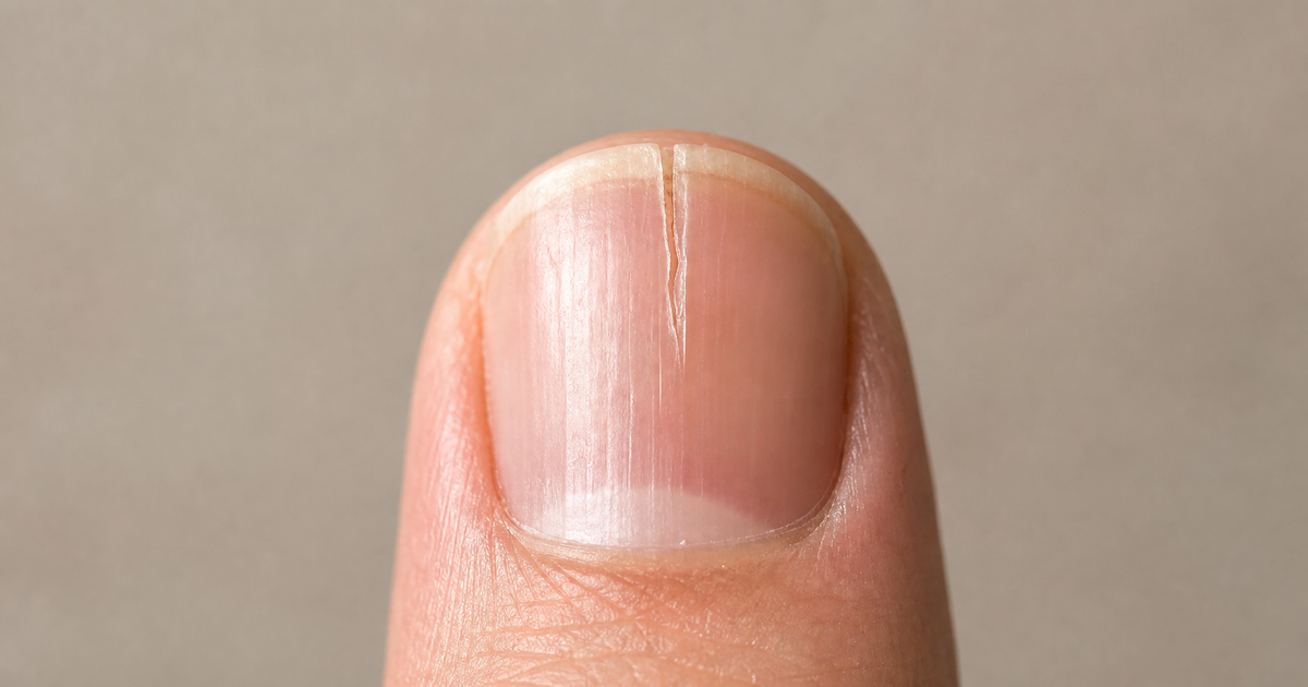 Pourquoi mon ongle se fend toujours au même endroit et comment le réparer ?